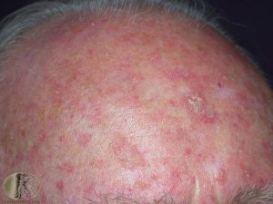 actinic keratosis scalp systems