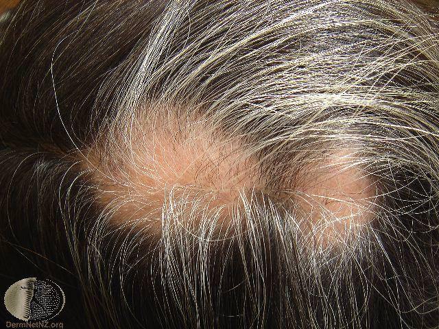 Hair Loss Treatment - Alopecia Treatment - Colorado Springs & Monument