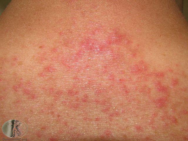 itchy skin hives