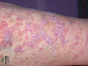 Lichen Planus Pictures