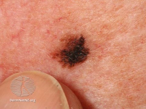 Melanoma Treatment & Information - Colorado Springs & Monument, CO