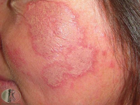 Cutaneous Lupus Treatment- Colorado Springs & Monument, CO