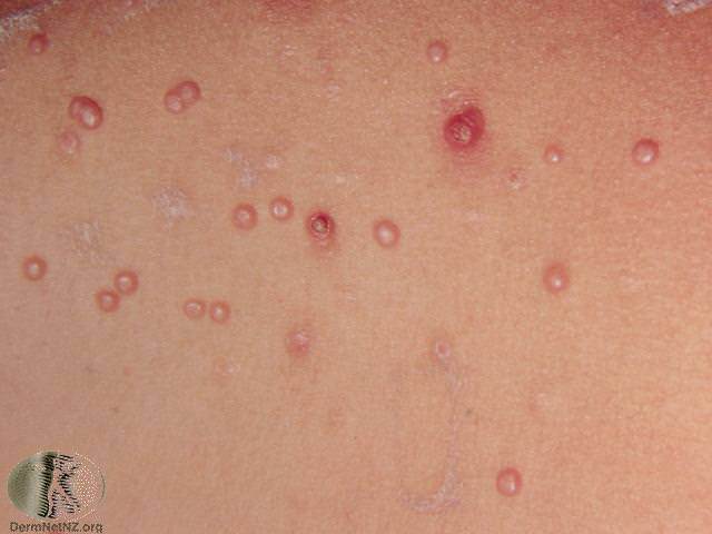 What Is Curettage Treatment For Molluscum Contagiosum 1267