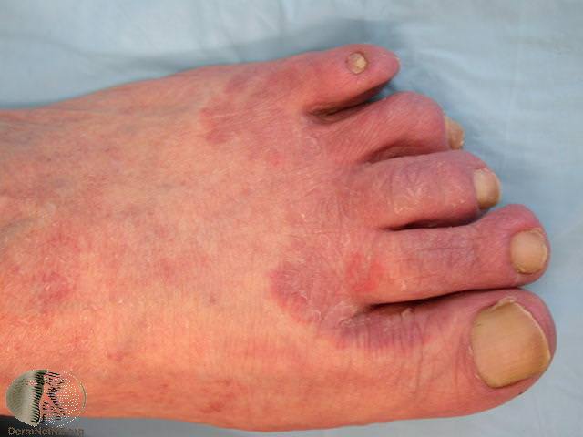 Tinea Pedis Athletes Foot Fungal Infection Stock Photo 1498532477